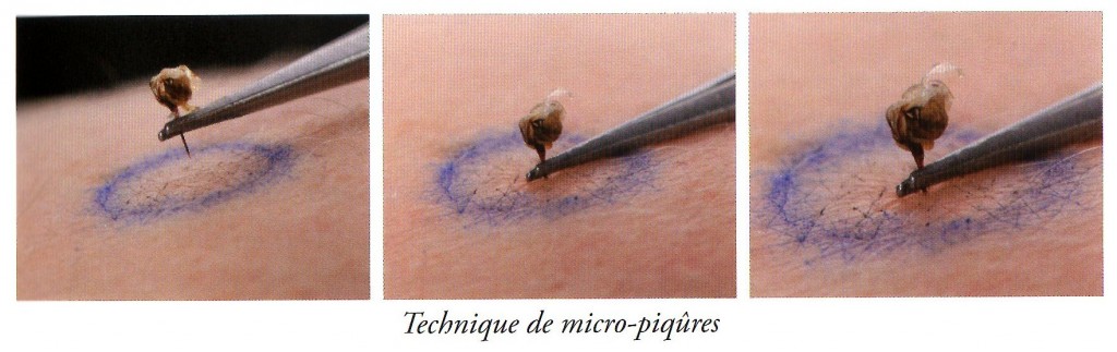 venin abeille