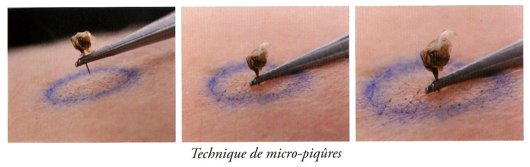 venin abeille